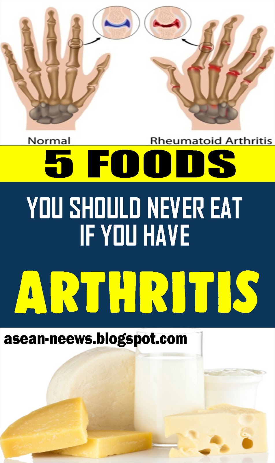 9 FOODS YOU SHOULD NEVER EAT IF YOU HAVE ARTHRITIS!