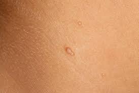infezione mollusco contagioso