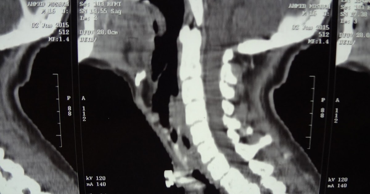 laryngeal tracheal stenosis grade IV . UPPER airway stenosis due to