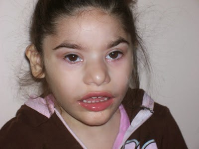 Синдром орбели картинки