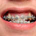 Quy trình niềng răng an toàn tại nha khoa