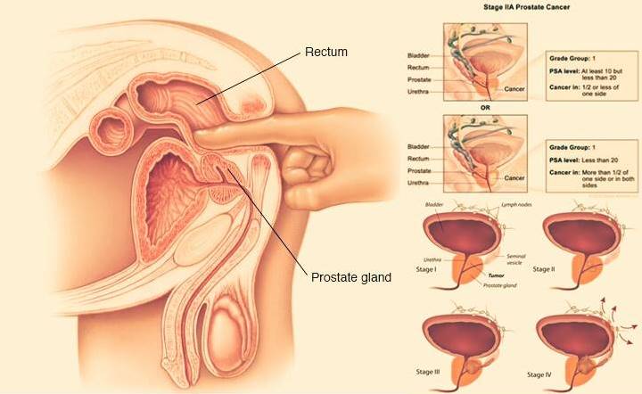 Prostat Cancer; Mengobati kanker prostat secara alami, 