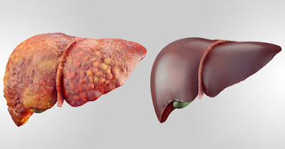 طرق طبيعية لتنظيف الكبد من السموم
