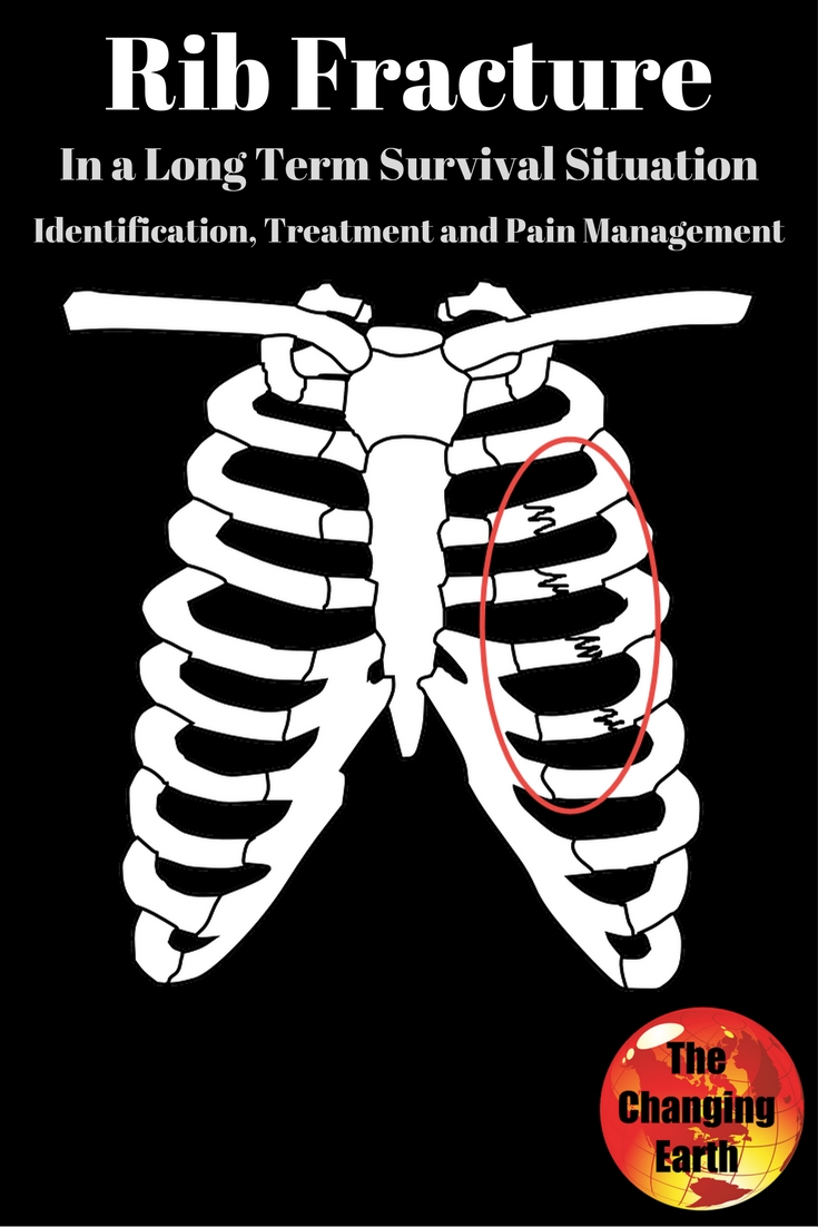 The Changing Earth Rib Fracture, In a Long Term Survival Situation