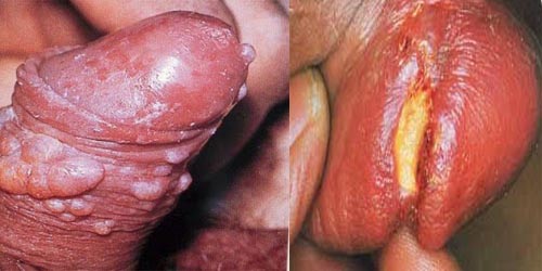 Jual Obat Sipilis De Nature Pengiriman ke Sidenreng Rappang