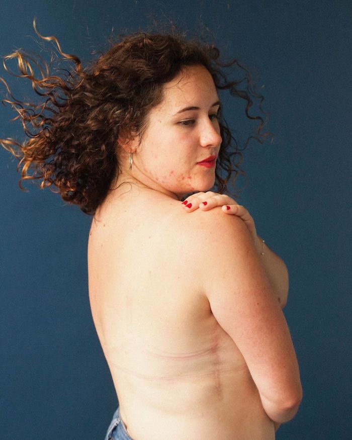 Photographer Captures People And Their Unique Scars In An Inspiring 'Behind The Scars' Photo Project