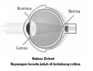 Rabun dekat (hipermetropi)