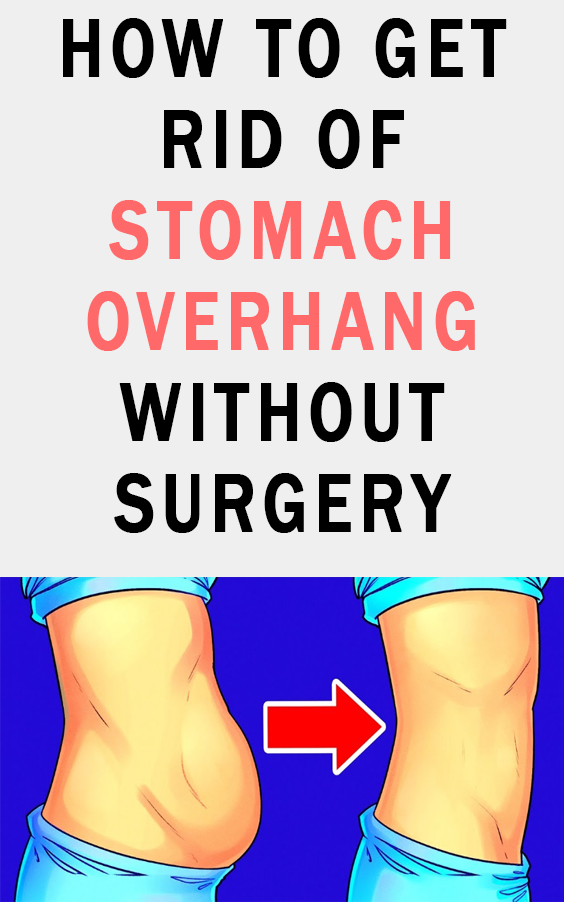 10 Tips On How To Get Rid Of Stomach Overhang Without Surgery Hello