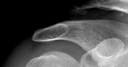 Shoulder Arthritis / Rotator Cuff Tears causes of