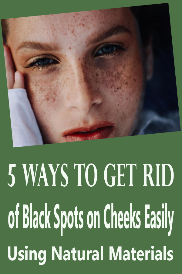 5 Ways to Get Rid of Black Spots on Cheeks Easily Using Natural