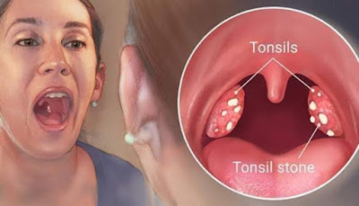 Surgical treatment of tonsils without surgery