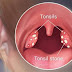 Surgical treatment of tonsils without surgery
