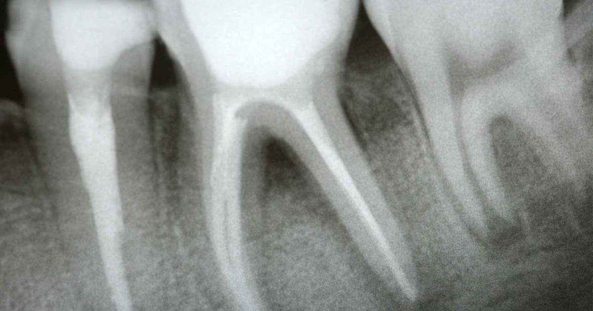 Leaked XRays Reveal 3Teeth Has Had Two Root Canals Riveting News