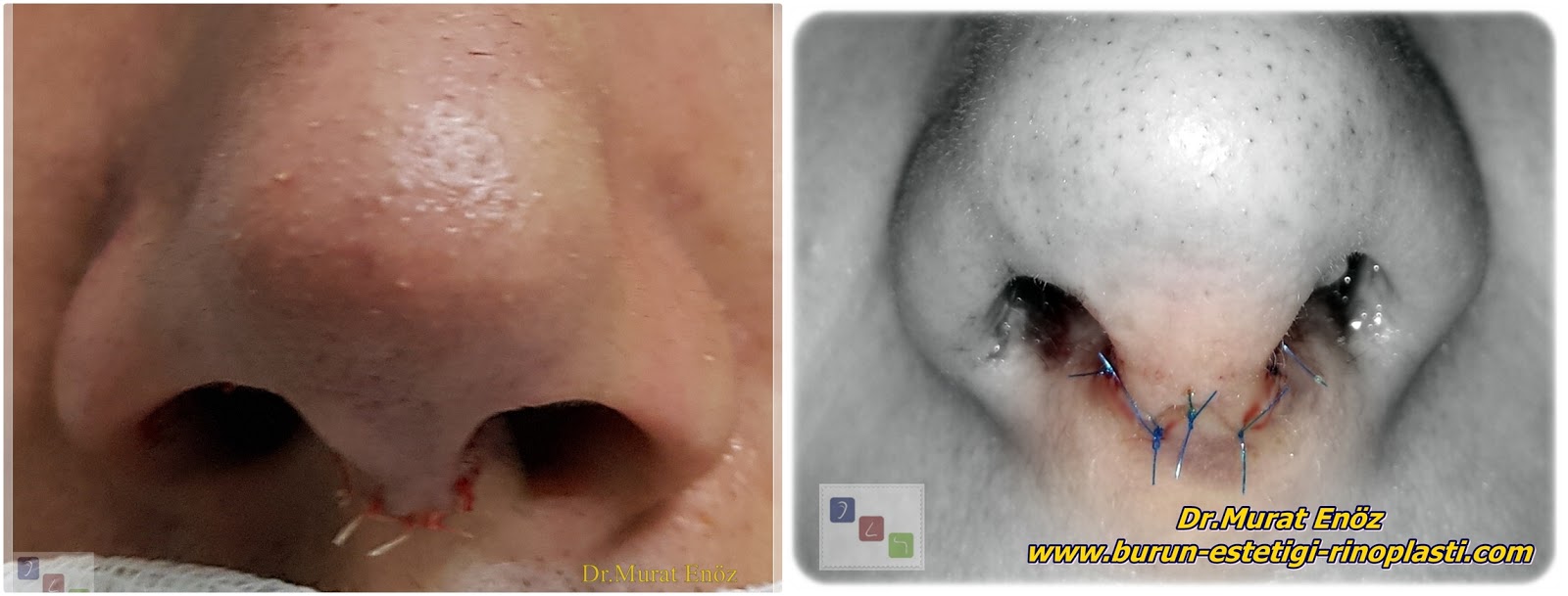 Burun Estetiği Ameliyatı Rehberi 👃 46 Burun Ucundaki Dikişler Ne