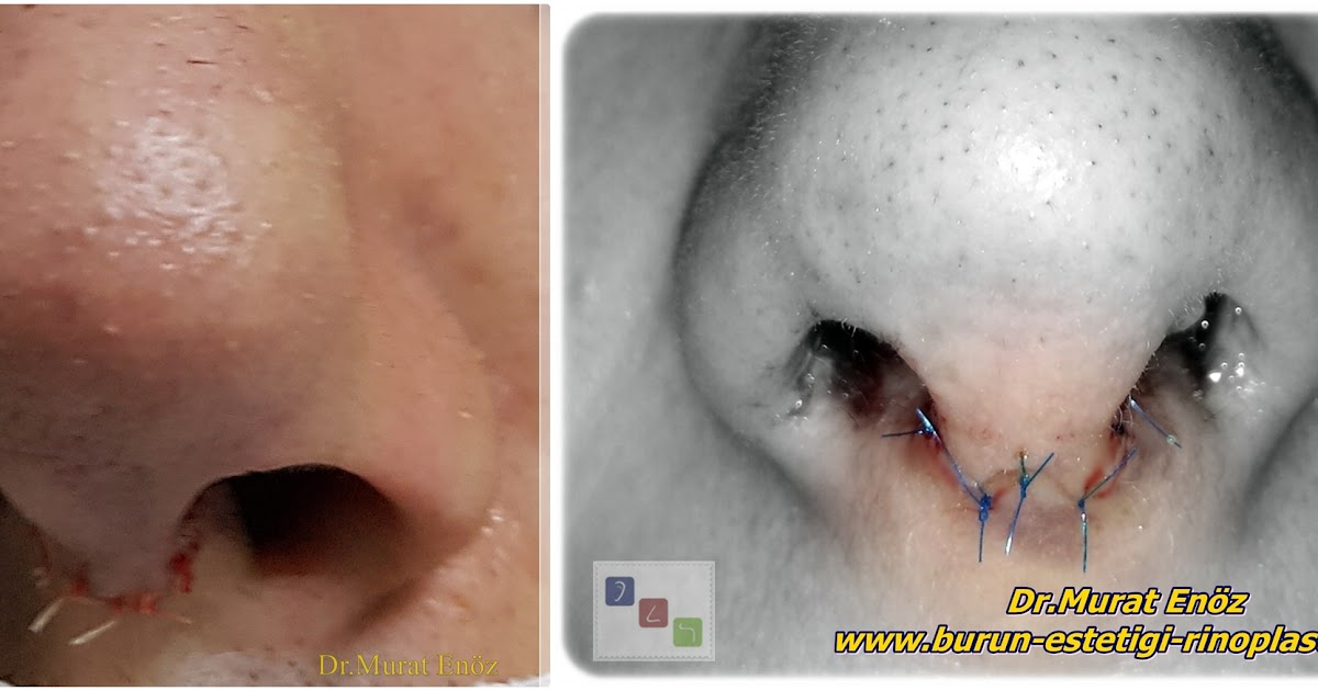 Burun Estetiği Ameliyatı Rehberi 👃 46 Burun Ucundaki Dikişler Ne