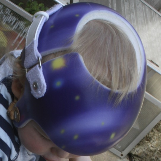 Turning Dutch Helmet Therapy in the Netherlands