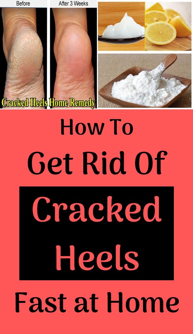 How To Get Rid Of Dry Feet With Natural Remedies WEDDING AND WOMEN LIFE
