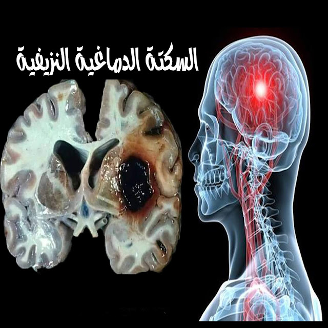 السكتة الدماغية - اسباب , اعراض و علاج مرض السكتة الدماغية