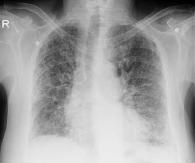 New Targeted therapies developed to reduce lung fibrosis