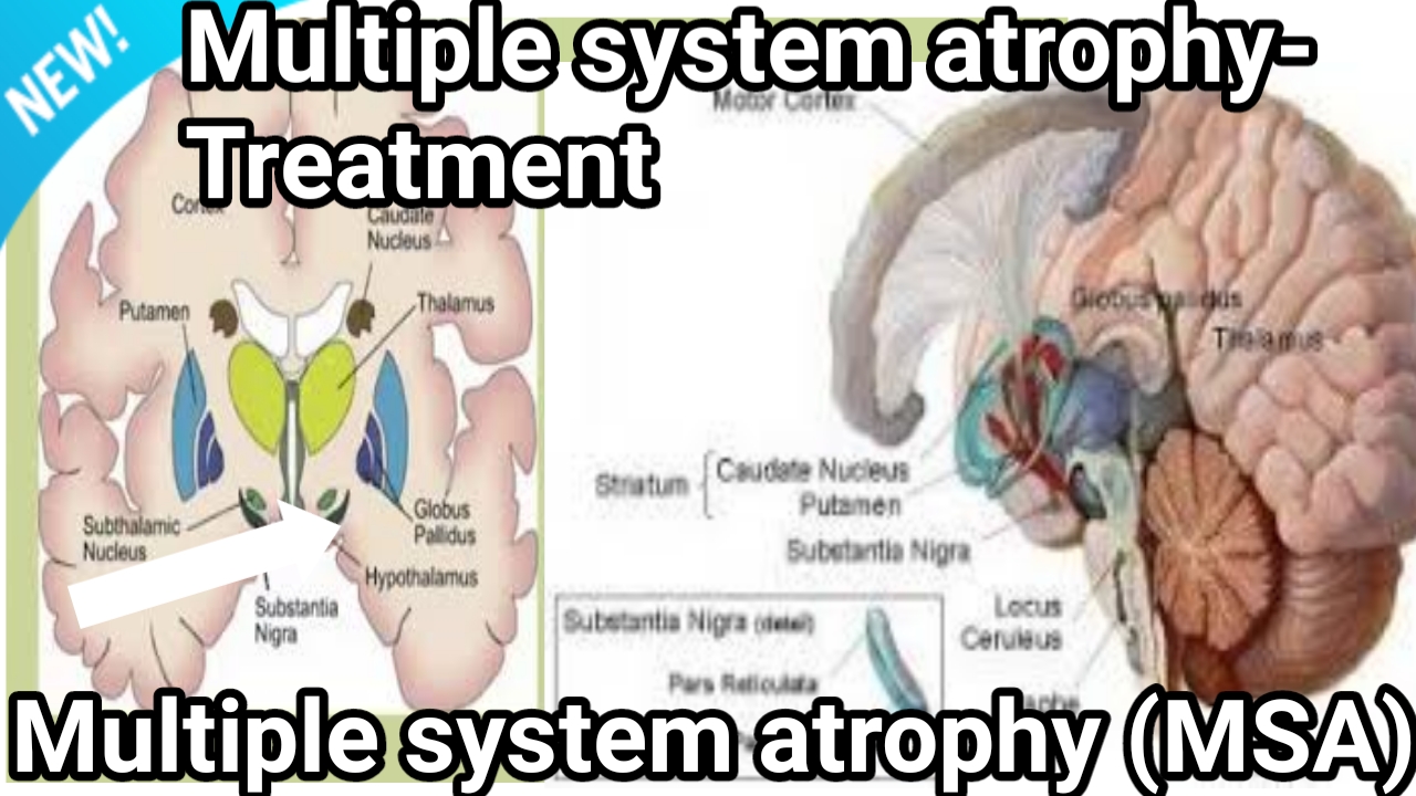 msa disease Multiple system atrophy (MSA) symptoms, diagnosis