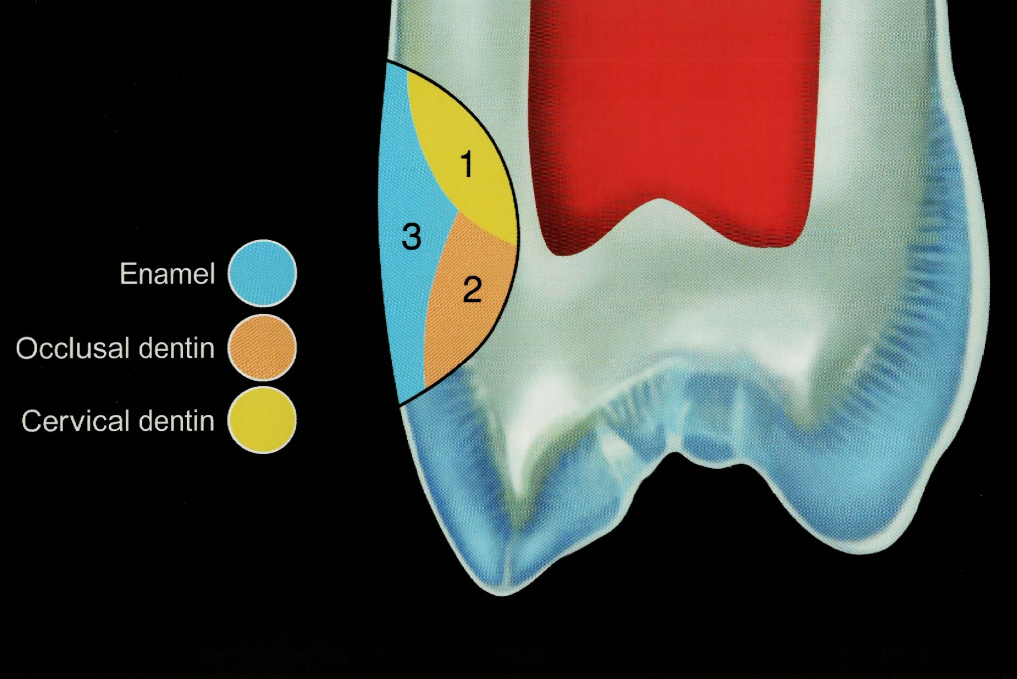 Class V composite restoration " Noncarious lesion " Dental Esthetics