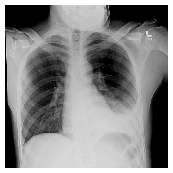 Chest XRays Mind The Bleep