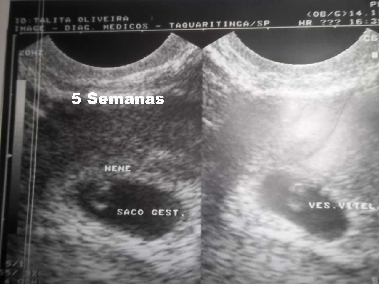 Mamãe Integral Moderna: Ultrassons 5 a 14 semanas