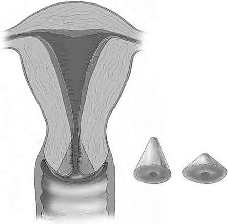 Conization of the cervix