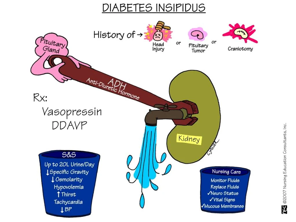 Captivating What Are The Causes Of Diabetes Insipidus Scene in HD Captivating What Are The Causes Of Diabetes Insipidus Scene in HD