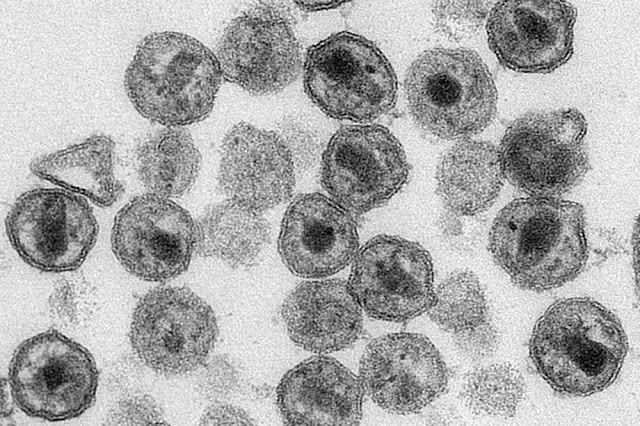 Teste de fase 1 mostra que vacina contra o HIV é capaz de estimular produção de células do sistema imune, dizem pesquisadores