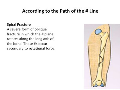 treatment of a spiral fracture treatment of a spiral fracture