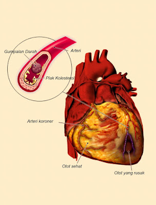  Pengertian Penyakit Jantung Koroner