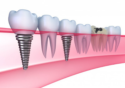 Implant phục hình răng có hiệu quả cao