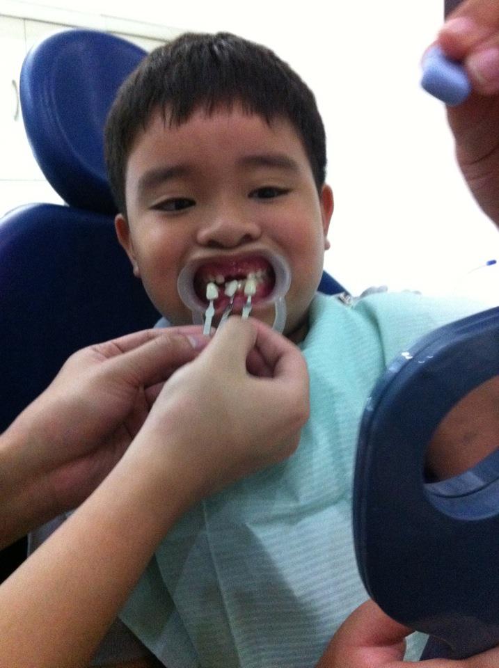 m♥mmil♥ve Space Maintainers with Artificial Teeth