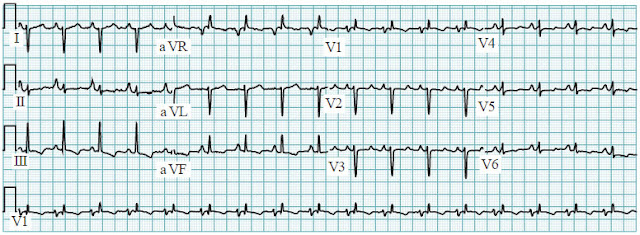 pulmonary hypertension ECG