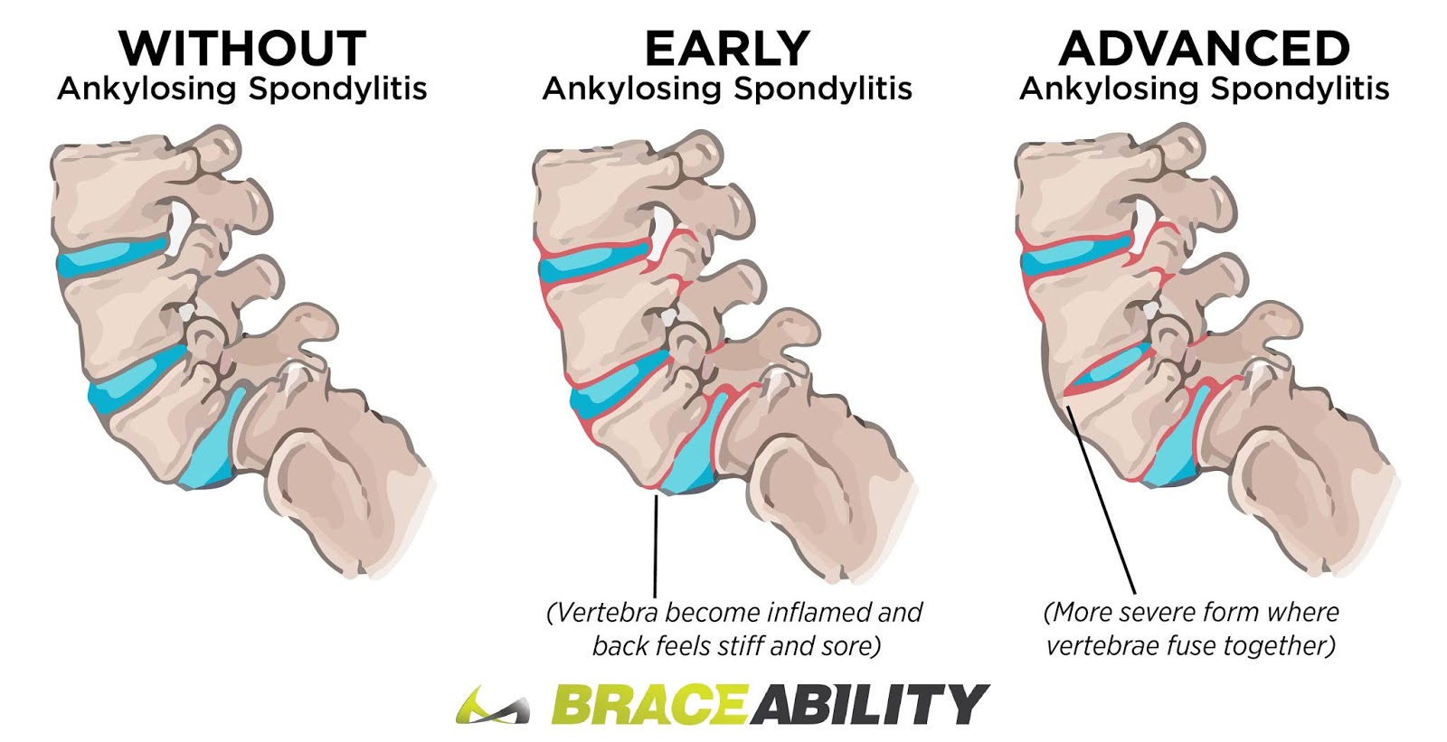 Inovasi Novartis untuk Ankylosing Spondylitis dan Psoriatic Arthritis