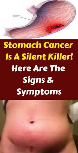 Signs And Symptoms of Stomach Cancer !