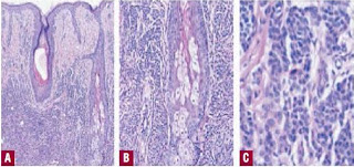 PUBLIC HEALTH: TUMOR MELANOCYTIC; Congenital Nevomelanocytic Nevus ...