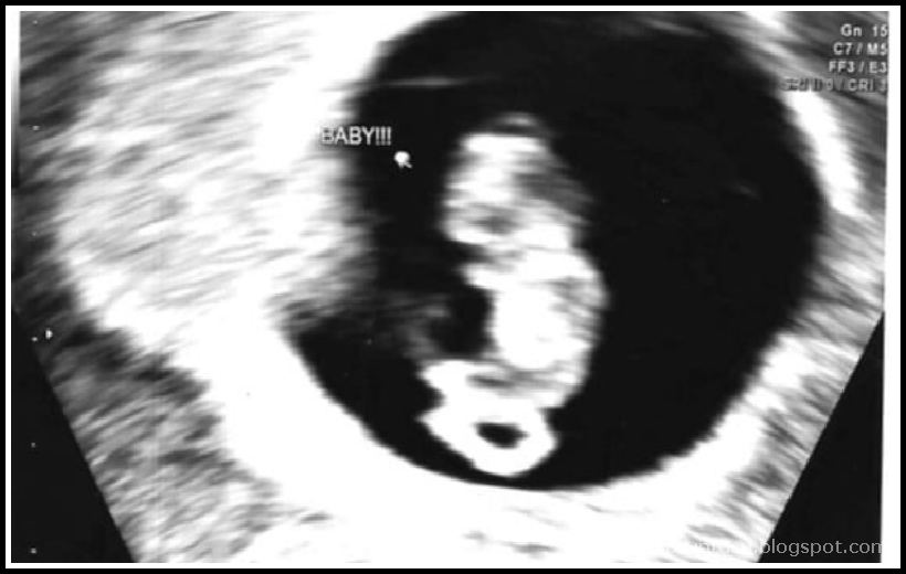 Gebelik Görüntüsü