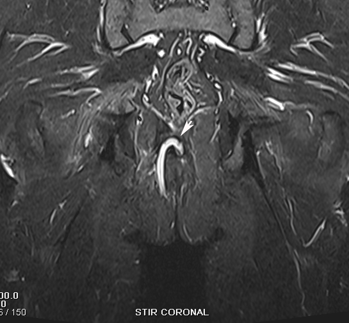 fistulas in Perianal