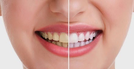 10 Cara menjaga gigi dan mulut secara alami