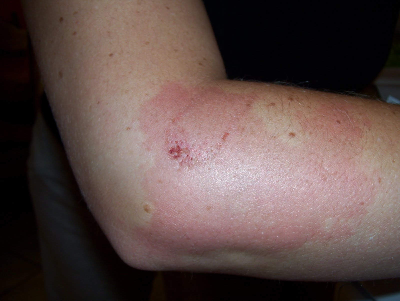 Life Sure is a Zipdinger! Maimed by a firework