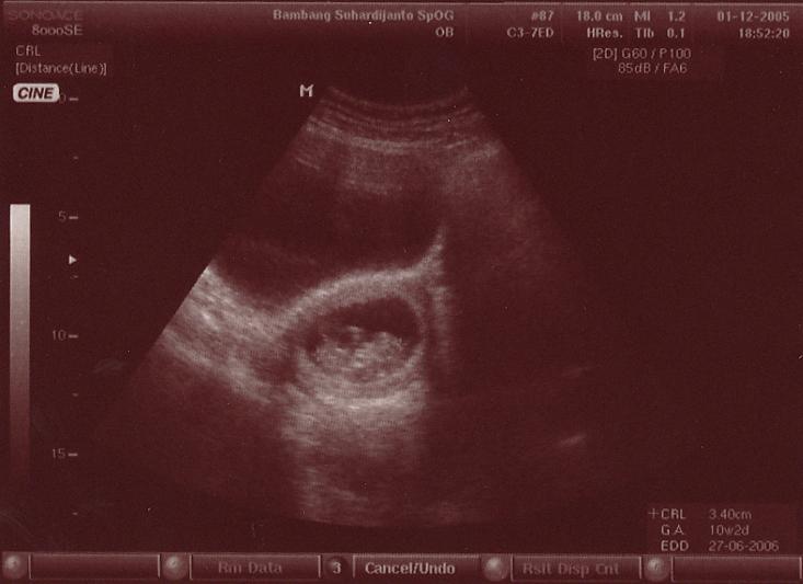 Pengalaman Pertama USG Port Article