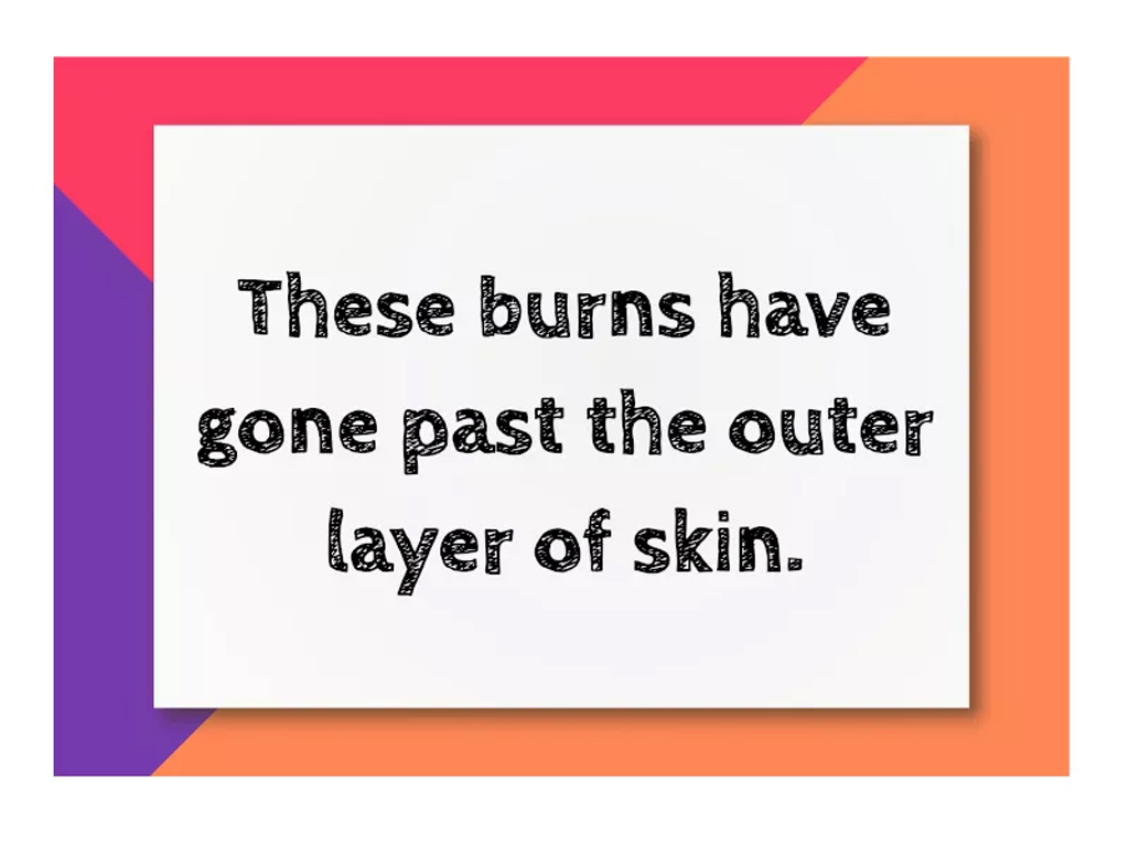 Second-Degree Burns (Partial Thickness) Everything You Should Learn About Burns