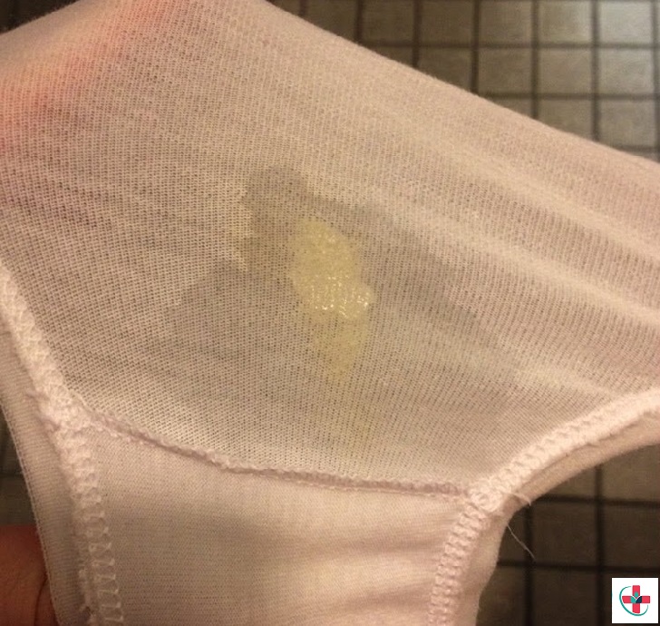 Is white crusty discharge in underwear from