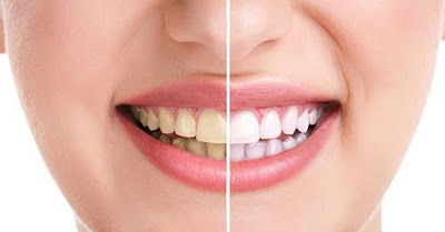 Ưu điểm của phương pháp tẩy trắng răng