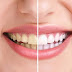 Ưu nhược điểm của phương pháp tẩy trắng răng