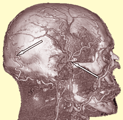 Migraine Vessels