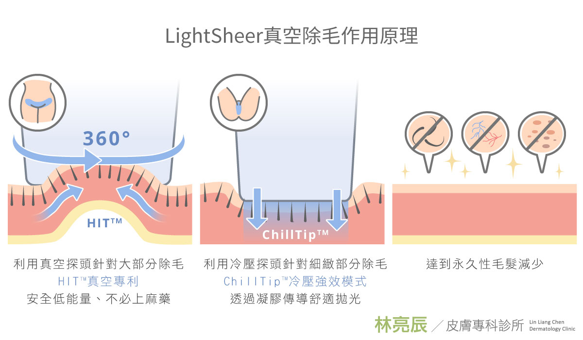 真空除毛費用價格真空除毛缺點lightsheer臉部除毛腋下真空除毛手臂除毛真空除毛lightsheer私密處除毛比基尼除毛無痛除毛新竹林亮辰醫師新竹推薦醫師