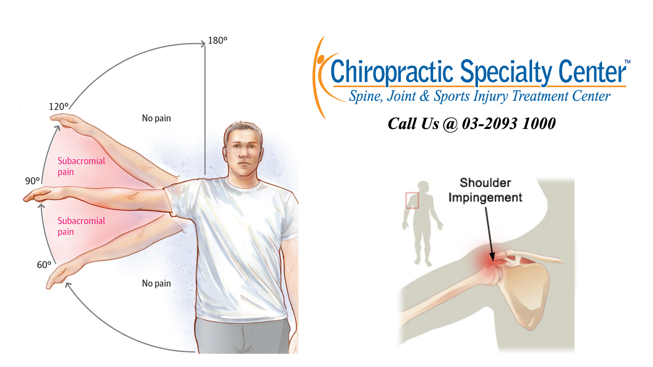 Резкая сильная боль в плечевом суставе. Синдром сдавления ротаторной манжеты плеча. Импиджмент синдром плеча. Импинджмент синдром плечевого сустава. Тестирование мышц вращательной манжетки плеча.
